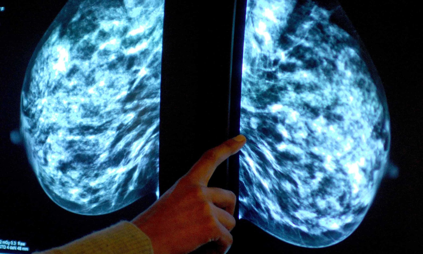 NHS Initiates Largest AI Trial for Breast Cancer Detection