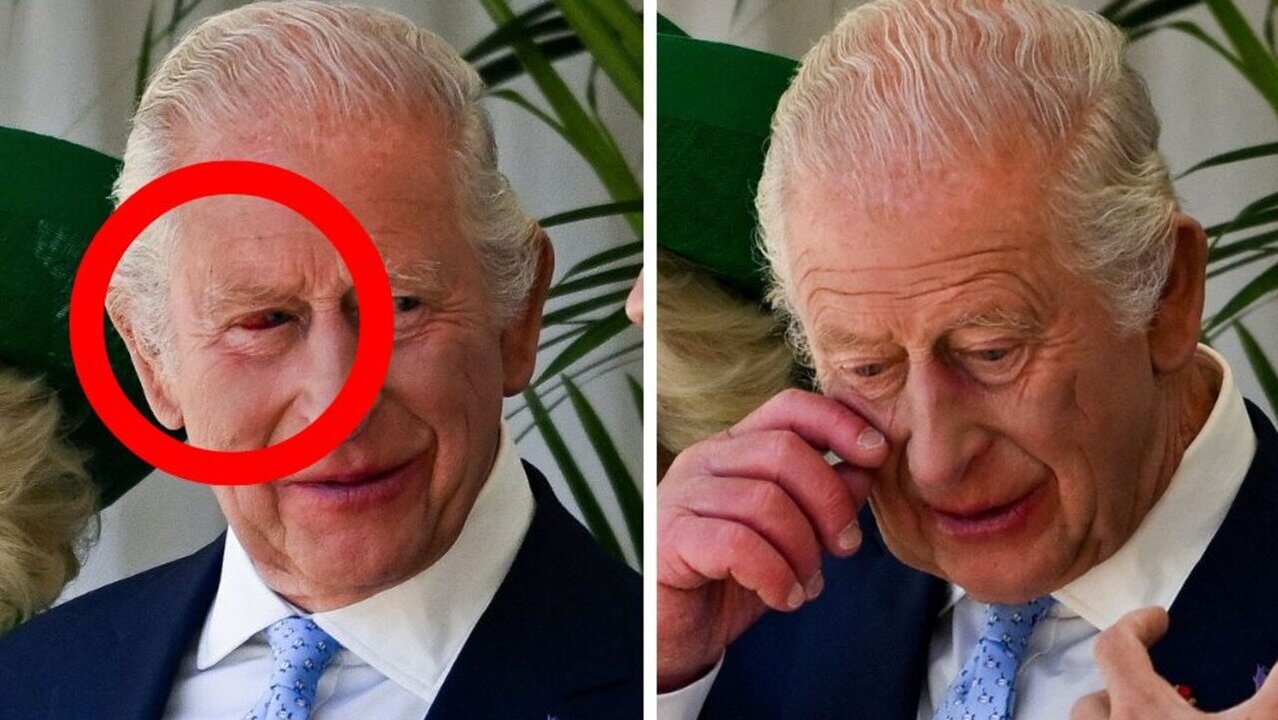 Palace Addresses Health Concerns After King Charles Appears with Red Eye
