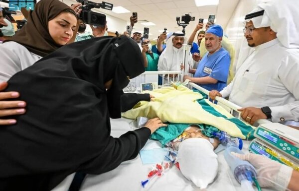 Saudi conjoined twins successfully separated in complex 12.5-hour surgery