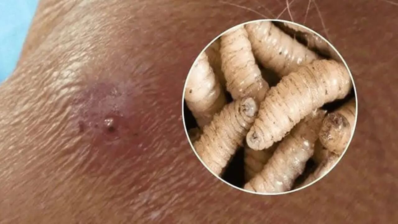Costa Rica Confirms 56 Cases of Human Screwworm Infection