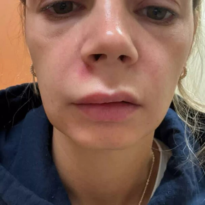 Woman Hospitalized After Popping Pimple in Dangerous Facial Area