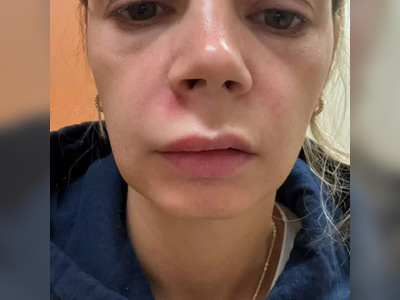 Woman Hospitalized After Popping Pimple in Dangerous Facial Area