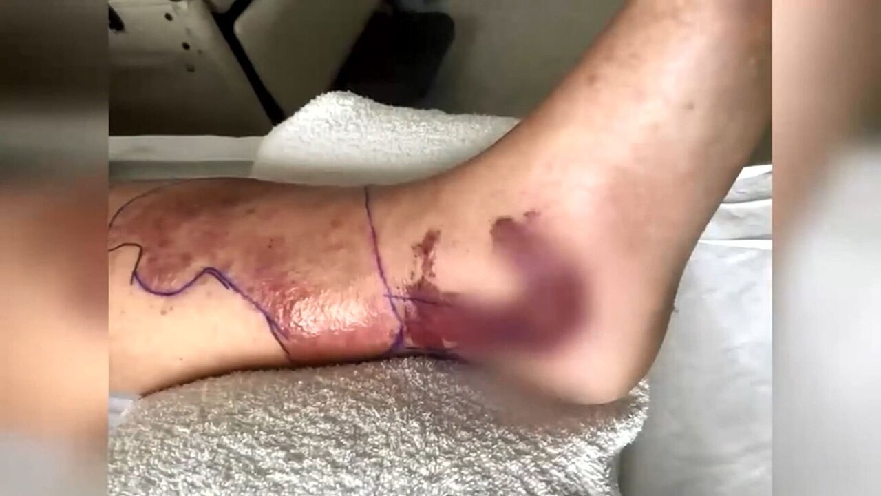 Man Returns From Panama With Flesh-Eating Parasite