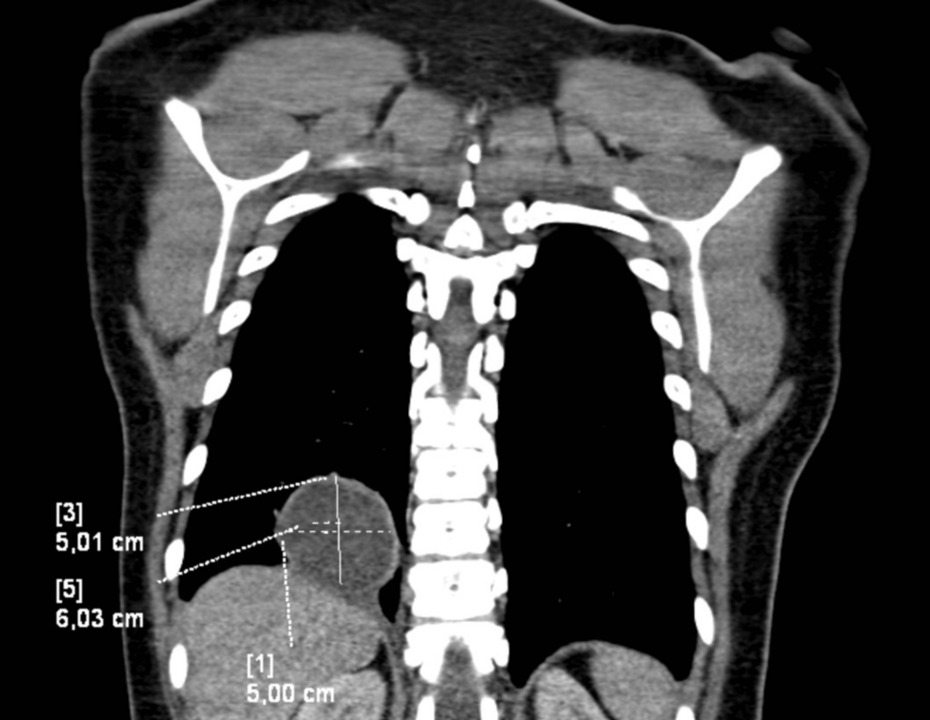 Rare Pulmonary Disease Cases Reported in Belgium