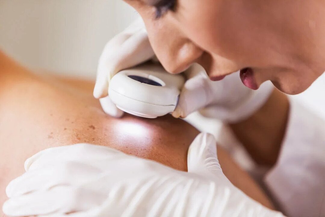 Australian Nurses Step Up to Combat Rising Skin Cancer Rates