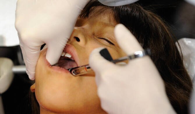Countries Agree to End Mercury Tooth Fillings by 2034