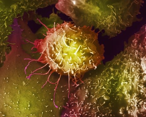 UK Panel Rejects Nationwide Prostate Cancer Screening, Endorses Targeted Testing for BRCA-Linked Risk